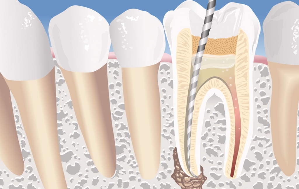 Endodonzia