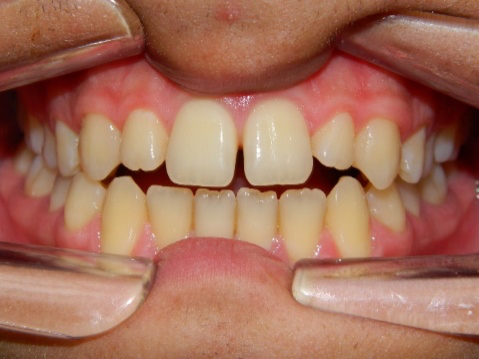 Esempio Denti Morso aperto - Studio Dentistico Strambi