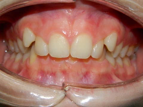 Esempio Denti coperti - Studio Dentistico Strambi
