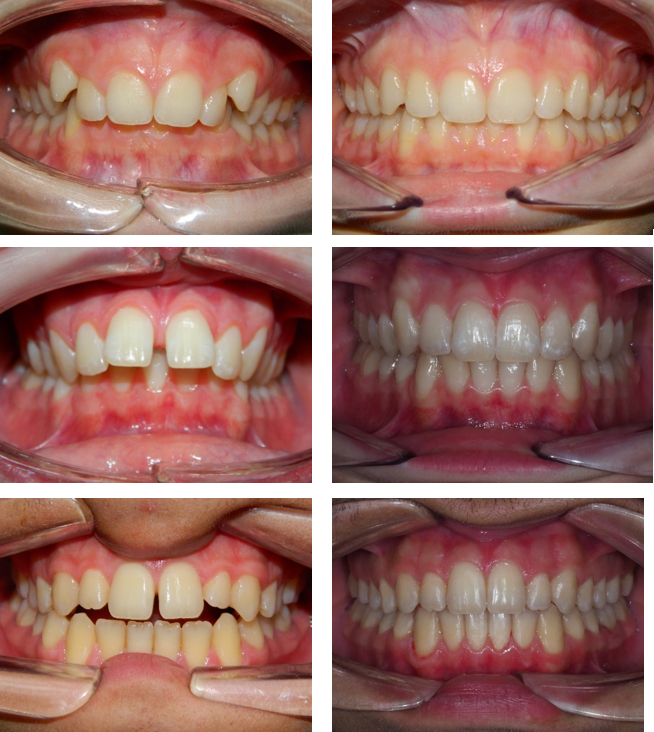Esempi casi pre e post cura allineatori trasparenti Dr. Strambi