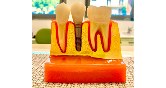 Hai perso uno o più denti e devi sottoporti all’implantologia?