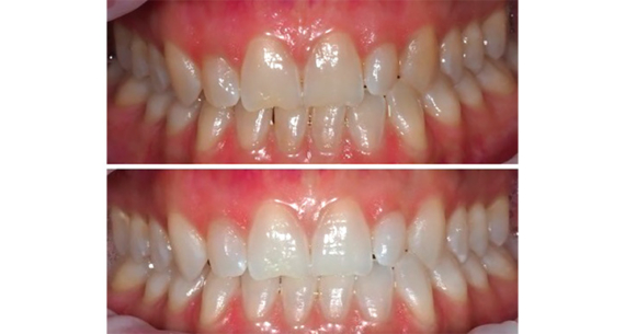 Vorresti ottenere denti più bianchi?