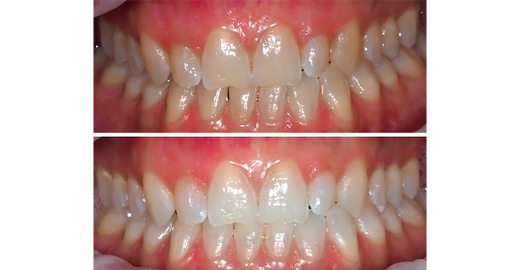 Vorresti ottenere denti più bianchi?