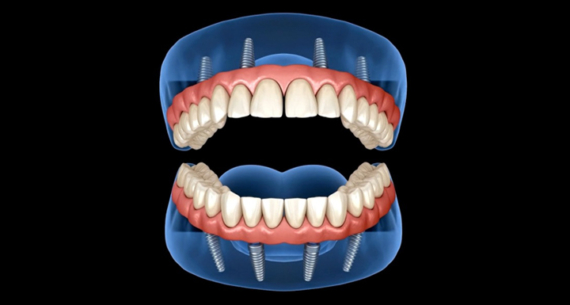 Cosa fare se hai perso tutti (o quasi) i tuoi denti?